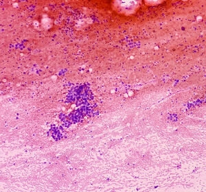 Anhaltendes Ansprechen auf Ramucirumab + Docetaxel nach frühem Erstlinienprogress