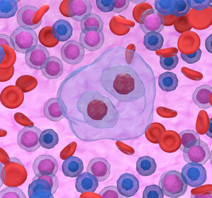 EHA: BrECADD neuer Standard beim fortgeschrittenen Hodgkin-Lymphom