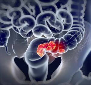 Metastasiertes BRAF V600E-mutiertes CRC: Erste Effektivitätsdaten zeigen den Nutzen von Encorafenib plus Cetuximab in der realen Population