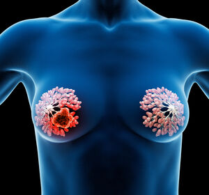 HER2-low mBC: Ergebnisse der DB04-Studie zeigen die Notwendigkeit einer differenzierteren Einteilung des HER2-Status