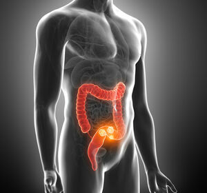 Metastasiertes Kolorektalkarzinom: Sotorasib/Panitumumab-Kombi verbessert OS im Trend