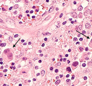 Vorläufige Phase-I/II-Daten bei r/r Lymphomen weisen auf sichere Bridging-Therapie mit Pirtobrutinib vor CAR-T-Zellen hin