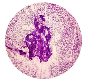 Encorafenib + Binimetinib beim fortgeschrittenen NSCLC mit BRAFV600E-Mutation – Neue Daten zum langanhaltenden Ansprechen  in der Erstlinie