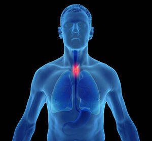 UCCL-IKF-SAGA-Studie: Vorbehandeltes, metastasiertes gastroösophageales Adenokarzinom