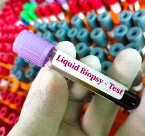 Liquid Biopsy bei Kopf-Hals-Tumoren für die klinische Diagnostik