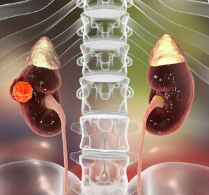 mRCC: Psychosoziale Aspekte und individualisierte Therapie mit TKI