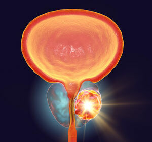 Update zur Anwendung von PARP-Inhibitoren beim mCRPC