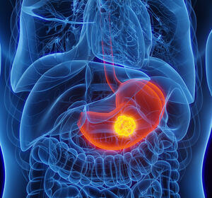 Zolbetuximab in der Therapie des Magenkarzinoms und die Bedeutung des Biomarkers Claudin 18.2