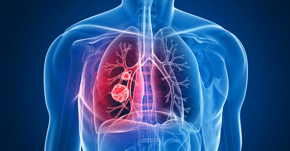 METex14-positives NSCLC: MET-Inhibitor – aktuelle Ergebnisse