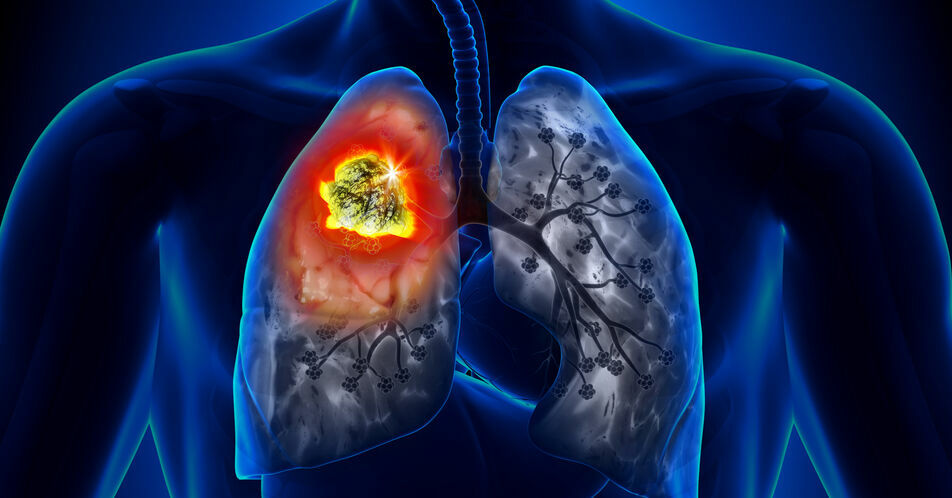 RET-Fusions-positives NSCLC: Zulassung für Pralsetinib