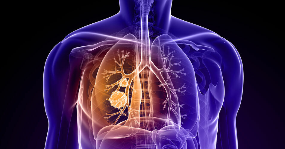 Pralsetinib: Erste First-Line-Therapie beim RET-Fusions-positiven NSCLC