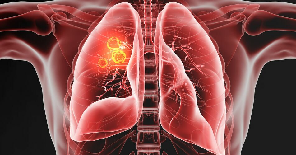 Fortgeschrittenes NSCLC: Immuntherapie ermöglicht Langzeitüberleben