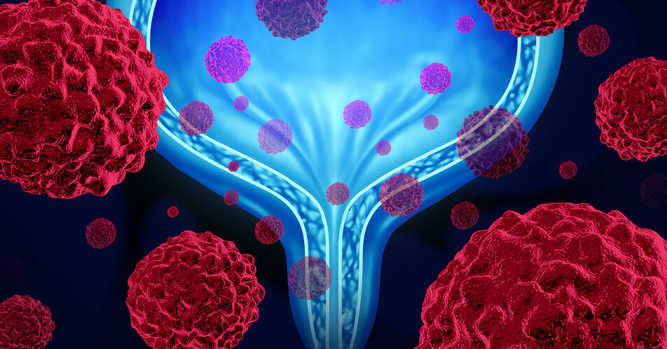 Urothelkarzinom: Was bedeuten die Daten zu Pembrolizumab?