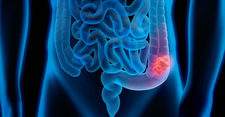Therapieoptionen beim metastasierten kolorektalen Karzinom