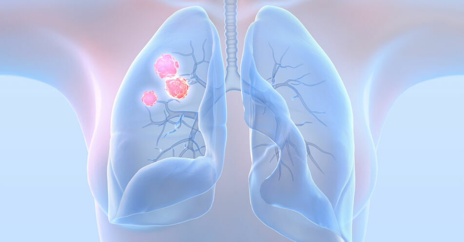 Neuer Ansatz für die zielgerichtete Therapie: METex14-Skipping-Mutation beim NSCLC