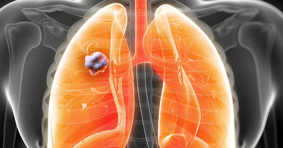 Seltene EGFR-Mutationen beim NSCLC: Neues Klassifikationsmodell liefert Hinweise für geeignete Therapie