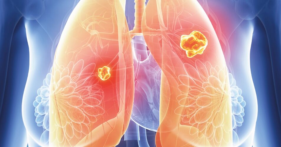 c-Met+ NSCLC: Phase-II-Studie mit Telisotuzumab Vedotin bei vorbehandelten Patient:innen