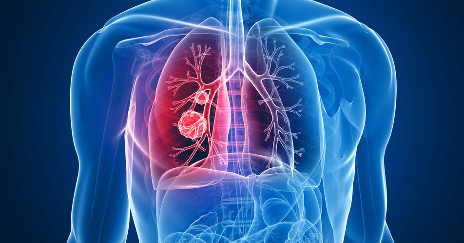 NSCLC: Personalisierte Medizin in verschiedenen Stadien