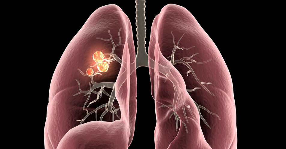 PD-L1-positives NSCLC: Cemiplimab + Chemotherapie in der Erstlinie