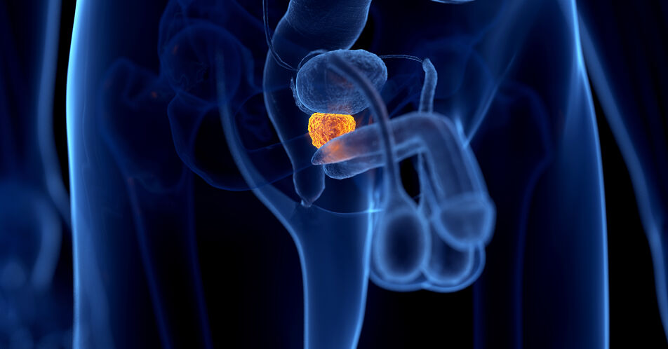 Aktuelle AUO-Studienaktivitäten in der Uro-Onkologie: Prostatakarzinom