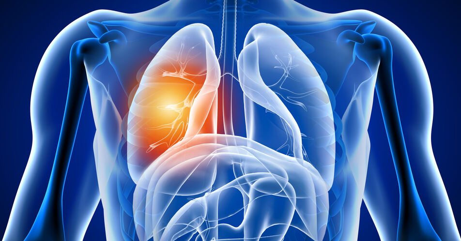 Metastasierte nicht-kleinzellige Lungenkarzinome – Aktuelles zur Therapie und Ausblick