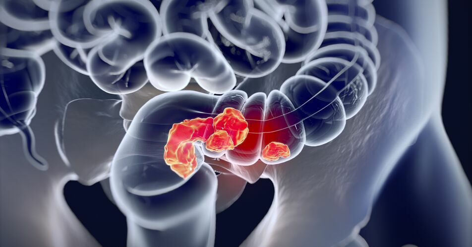 Metastasiertes BRAF V600E-mutiertes CRC: Erste Effektivitätsdaten zeigen den Nutzen von Encorafenib plus Cetuximab in der realen Population