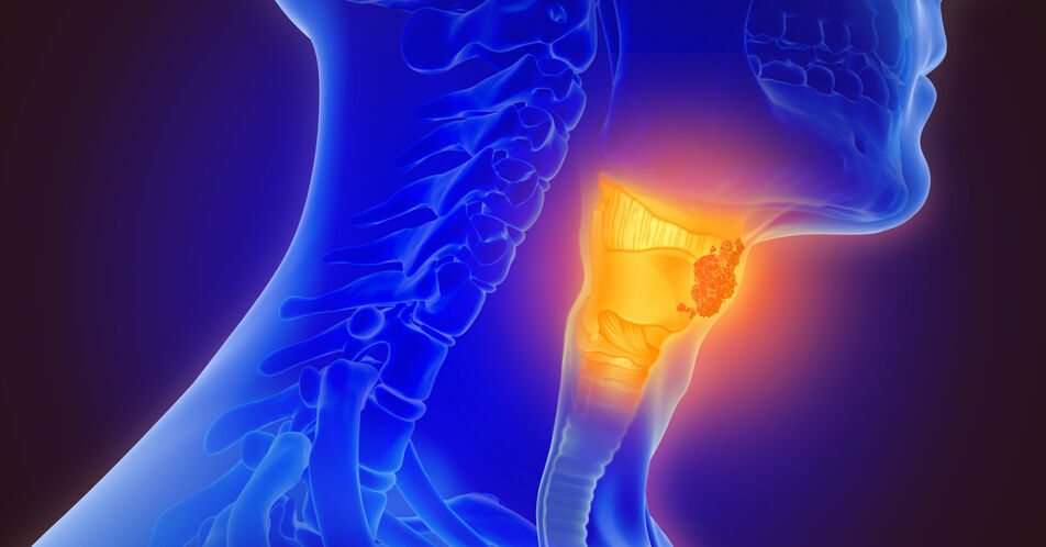 Fortgeschrittene Kopf-Hals-Tumoren: Welche Faktoren beeinflussen die Wahl der Erstlinie?
