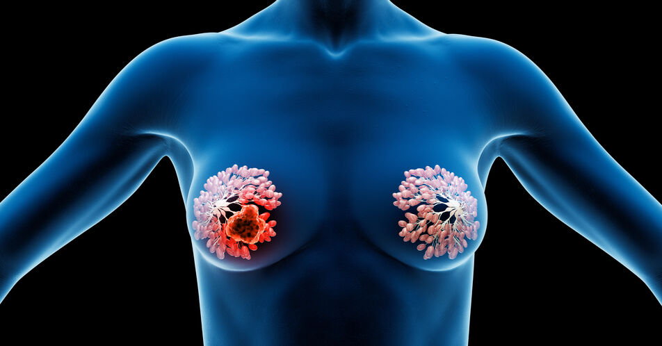 HER2-low mBC: Ergebnisse der DB04-Studie zeigen die Notwendigkeit einer differenzierteren Einteilung des HER2-Status