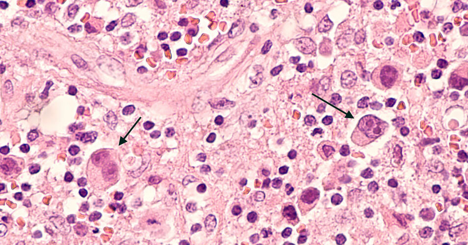 Vorläufige Phase-I/II-Daten bei r/r Lymphomen weisen auf sichere Bridging-Therapie mit Pirtobrutinib vor CAR-T-Zellen hin