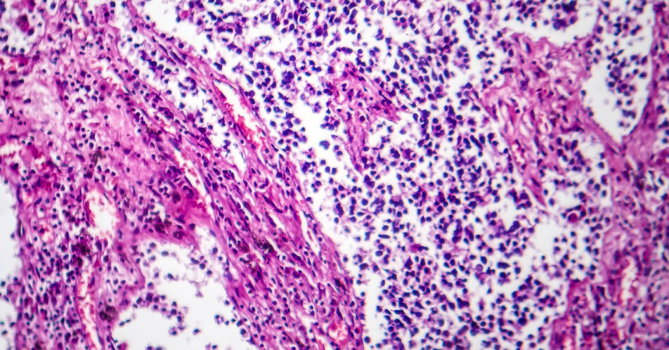 Fortgeschrittenes EGFRm NSCLC – Bei Bedarf für intensivere Erstlinientherapie: Zulassung für Osimertinib + Platin-Pemetrexed