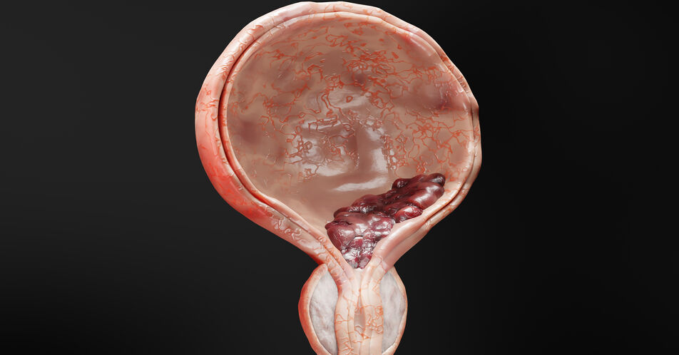 Enfortumab Vedotin + Pembrolizumab: Neuer Standard für die Erstlinienbehandlung bei ­fortgeschrittenem Urothelkarzinom