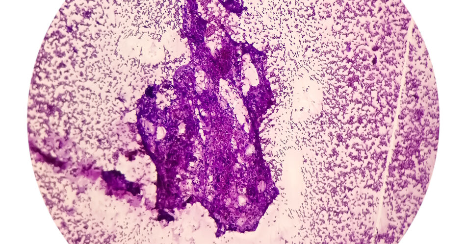 Encorafenib + Binimetinib beim fortgeschrittenen NSCLC mit BRAFV600E-Mutation – Neue Daten zum langanhaltenden Ansprechen  in der Erstlinie