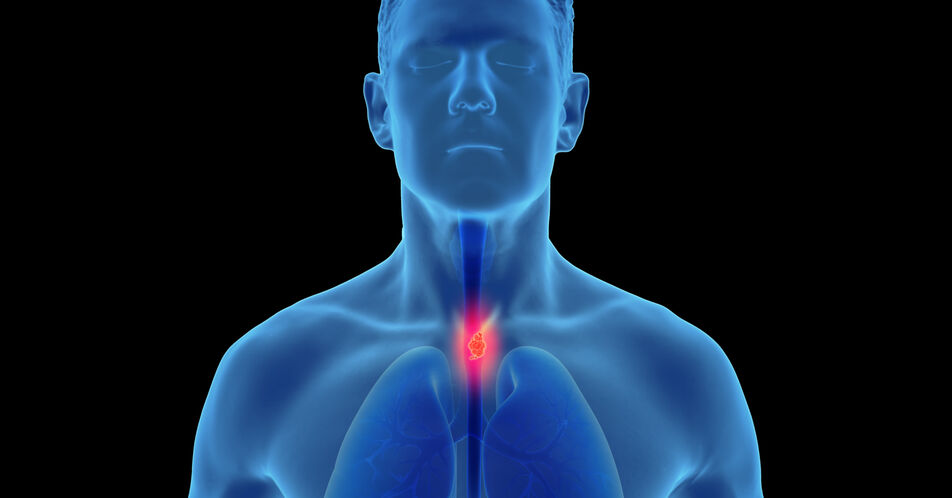 UCCL-IKF-SAGA-Studie: Vorbehandeltes, metastasiertes gastroösophageales Adenokarzinom