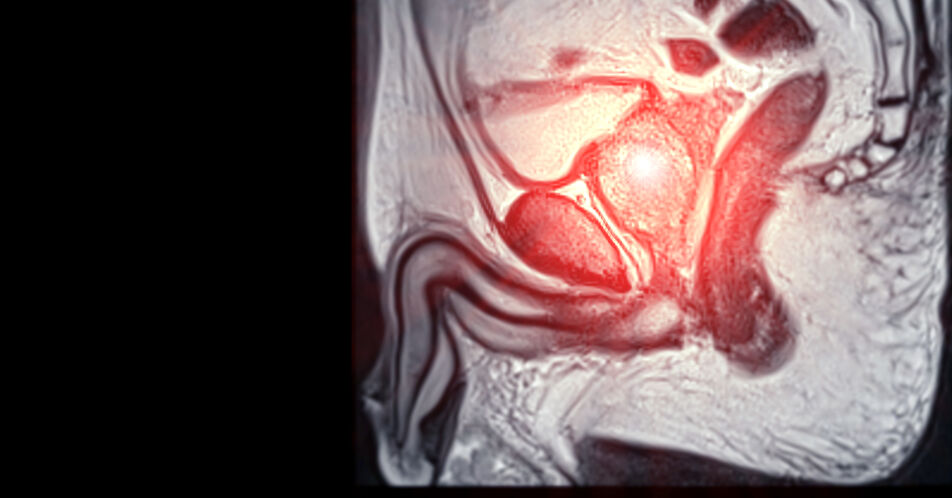 Darolutamid + Docetaxel und ADT beim mHSPC: Aktuelle Daten bestätigen Nutzen der frühen Therapieintensivierung