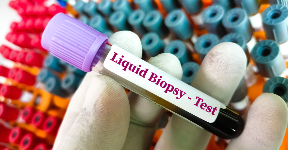 Liquid Biopsy bei Kopf-Hals-Tumoren für die klinische Diagnostik