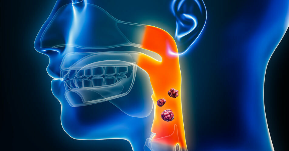 ESMO 2024: Nach Versagen von Checkpoint-Inhibitoren ist Paclitaxel + Cetuximab eine potenzielle Zweitlinientherapie bei r/m SCCHN