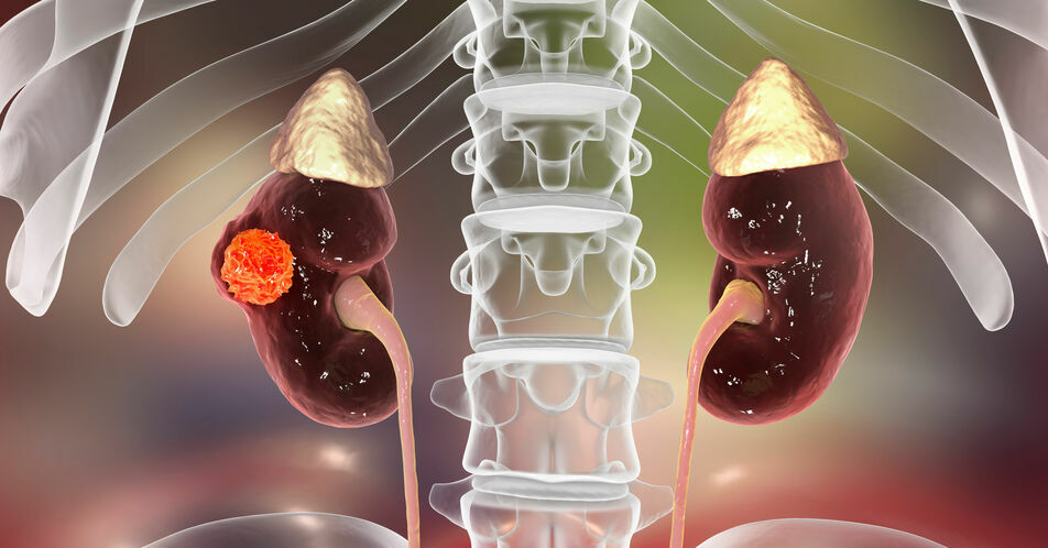mRCC: Psychosoziale Aspekte und individualisierte Therapie mit TKI