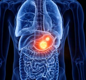 Ramucirumab: Bestätigter Standard in der Zweitlinie des fortgeschrittenen Magenkarzinoms