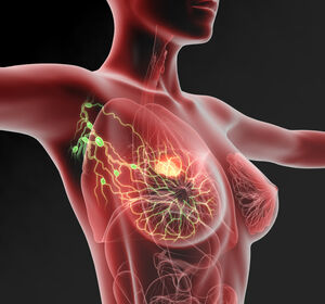 PIK3CA-mutierter Brustkrebs: Zielgerichtet behandeln mit Inavolisib