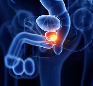 Prostatakarzinom: S3-Leitlinie zur häufigsten Krebserkrankung bei Männern aktualisiert
