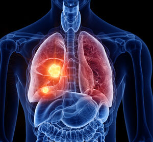 Zulassung von Amivantamab + Chemotherapie beim NSCLC mit aktivierenden EGFR-Exon-20-Insertionsmutationen