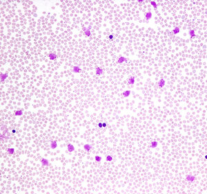 CLL: Neue Langzeitdaten zur Erstlinientherapie mit Ibrutinib plus Venetoclax