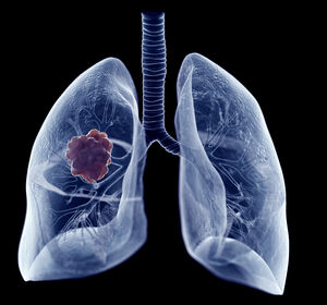 EGFR-mutiertes NSCLC: Zulassung von Osimertinib in Kombination mit Chemotherapie