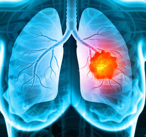 EGFRm NSCLC: Zweite Erstlinienoption mit Osimertinib ermöglicht intensivierte Therapie