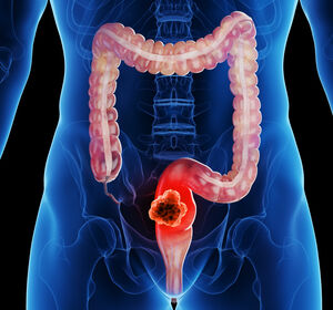 Entwicklungen in der Therapielandschaft des metastasierten Kolorektalkarzinoms: aktuelle Konzepte und neue Perspektiven