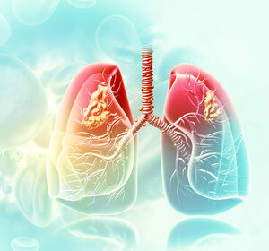 Globale Phase-III-Studie zu NSCLC mit HER2-Mutationen startet