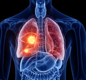 NSCLC mit BRAF-V600E-Mutation: Zulassung von Encorafenib + Binimetinib