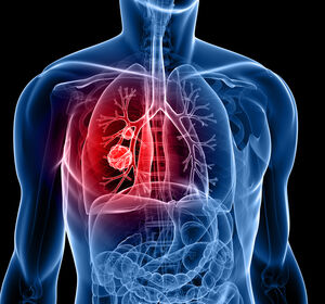 Erstlinientherapie des ALK+ NSCLC: 5-Jahres-Update der CROWN-Studie zu Lorlatinib