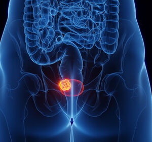  ESMO: Überlebensvorteil unter Enfortumab Vedotin + Pembrolizumab bei la/mUC unabhängig von der Nectin-4-Expression