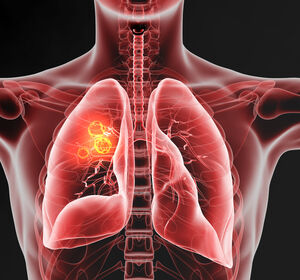 ESMO 2024: Wirksamkeit und Sicherheit von Belrestotug plus Dostarlimab bei Patient:innen mit PD-L1-hochgradigem LA/M-NSCLC